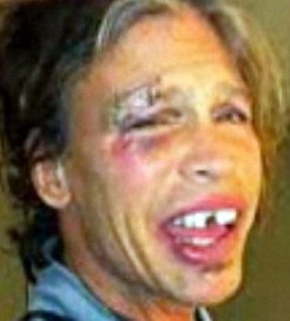 Η πρώτη φωτογραφία του Steven Tyler μετά την πτώση