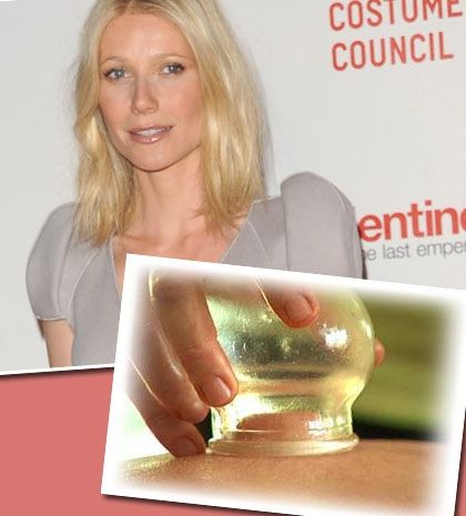 H Gwyneth εμπιστεύεται τις βεντούζες, οι γιατροί όμως όχι
