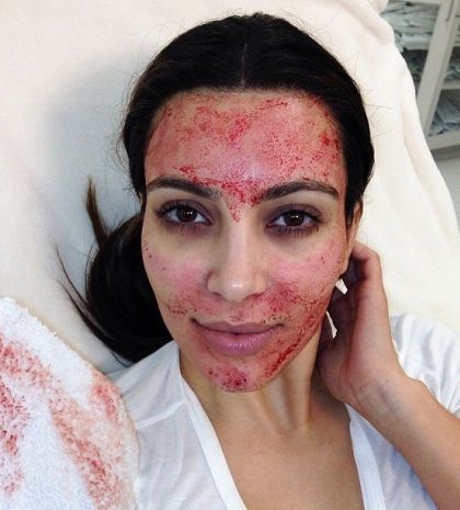 Vampire Facial: Αυτό είναι το treatment- εμμονή στο Hollywood