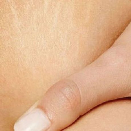 Πρόληψη κατά των ραγάδων με ένα μυστικό που κρύβεται στην κουζίνα!