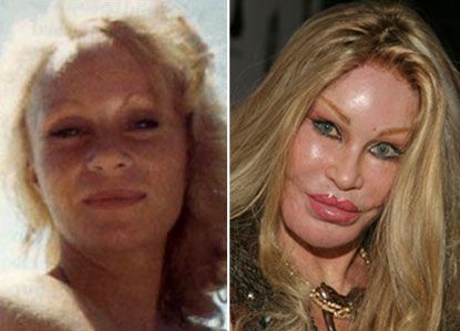 Σα να παραφούσκωσαν! Ποιες stars έχουν κάνει αποτυχημένες επεμβάσεις στα χείλη τους; (photos)