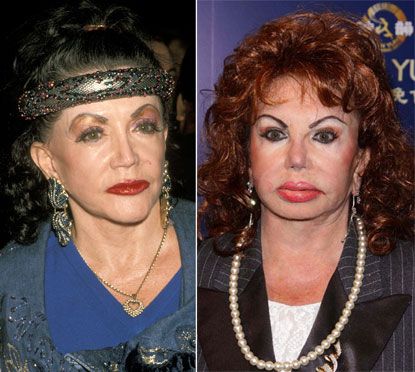 Σα να παραφούσκωσαν! Ποιες stars έχουν κάνει αποτυχημένες επεμβάσεις στα χείλη τους; (photos)