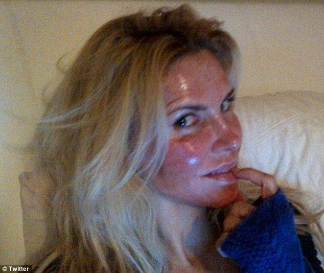 Ποια celebrity το παράκανε με τις θεραπείες και κατακάηκε σε πρόσωπο και χέρια;