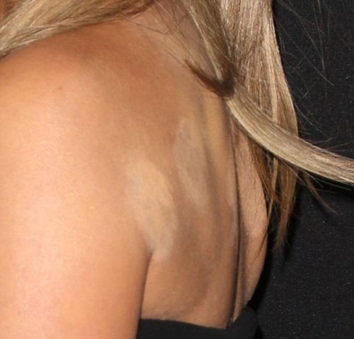 Η Jennifer Aniston κάνει βεντούζες