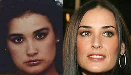 Ουπς: 16 stars πριν και μετά τις πλαστικές επεμβάσεις!