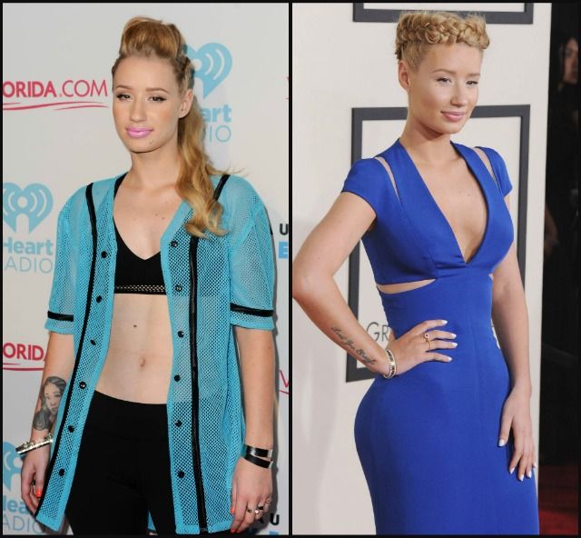 Iggy Azalea breast implants before after 7934a