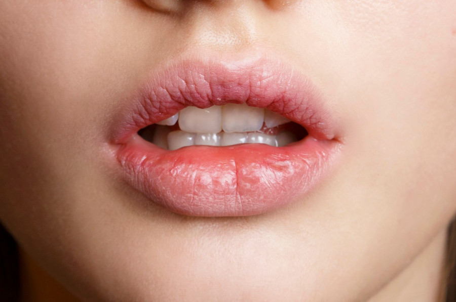 Acne emn S15 006