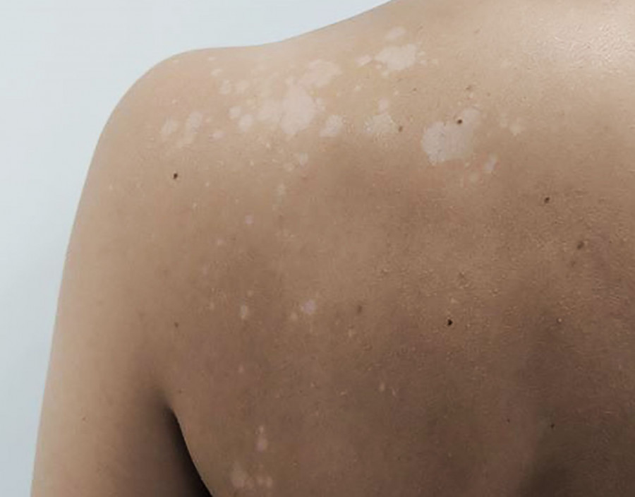 mikites epidermidas